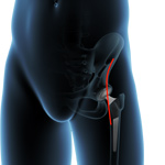 Anterior Hip Replacement