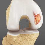 Articular Cartilage Injury