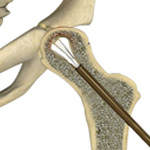 Core Decompression for Avascular Necrosis of the Hip