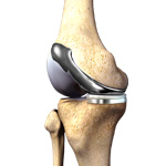 Custom Knee Replacement