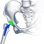 Custom/Patient-Specific Hip Replacement