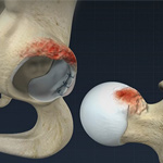 Femoroacetabular Impingement