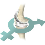 Gender-Specific Knee Replacement