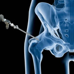 Hip Arthroscopy