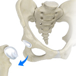 Hip Dislocation