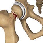 Hip Injury