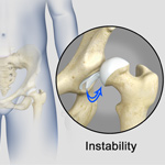 Hip Instability