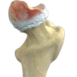 Hip Osteonecrosis
