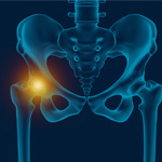 Hip Pain