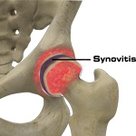 Hip Synovitis