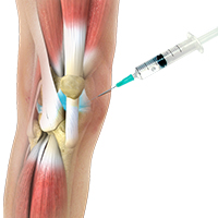 Hyaluronic Acid Injections