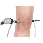 Knee Arthroscopy