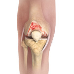 Knee Osteoarthritis