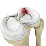 Meniscal Tears