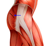 Mini-Posterior Hip Replacement