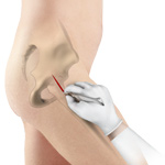 Minimally Invasive Total Hip Replacement