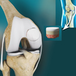 Osteochondral Defect of the Knee