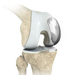 Unicompartmental/Partial Knee Replacement