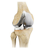 Partial Knee Resurfacing