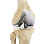 Partial Lateral Knee Replacement