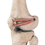 Patellofemoral Knee Replacement