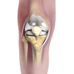 Patient Specific Knee Replacement