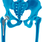 Reduced Risk Hip Replacement