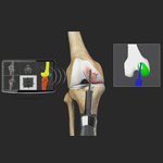 Robotic Unicondylar Knee Replacement