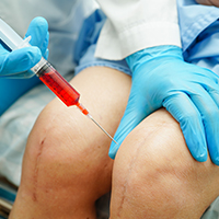 Stem Cell Therapy