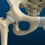 Stress Fractures of the Hip