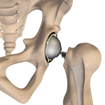 Total Hip Replacement