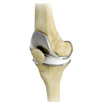 Total Knee Replacement