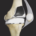 Tricompartmental Knee Replacement