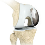 Unicondylar knee Replacement
