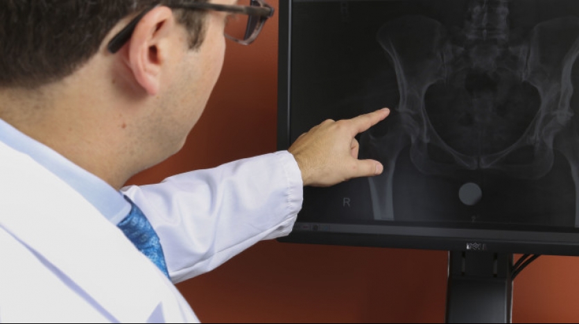 How Spinal Deformity Can Affect Hip Replacement Surgery Success Rates