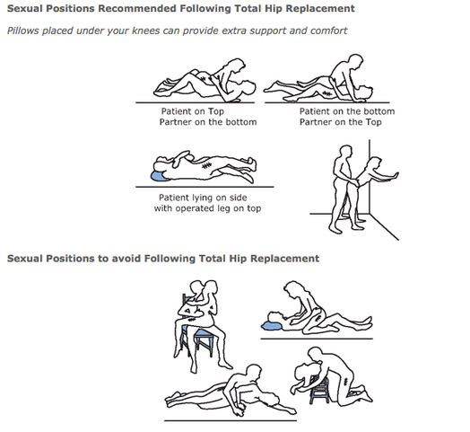 Sexual Activity After a Total Hip Replacement 